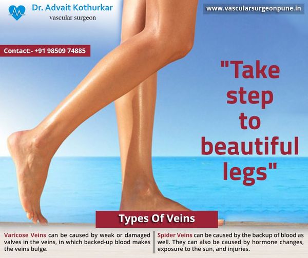 Varicose Veins Treatment in Pune :: Dr. Advait Kothurkar