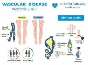 Varicose Veins | Dr. Advait Kothurkar