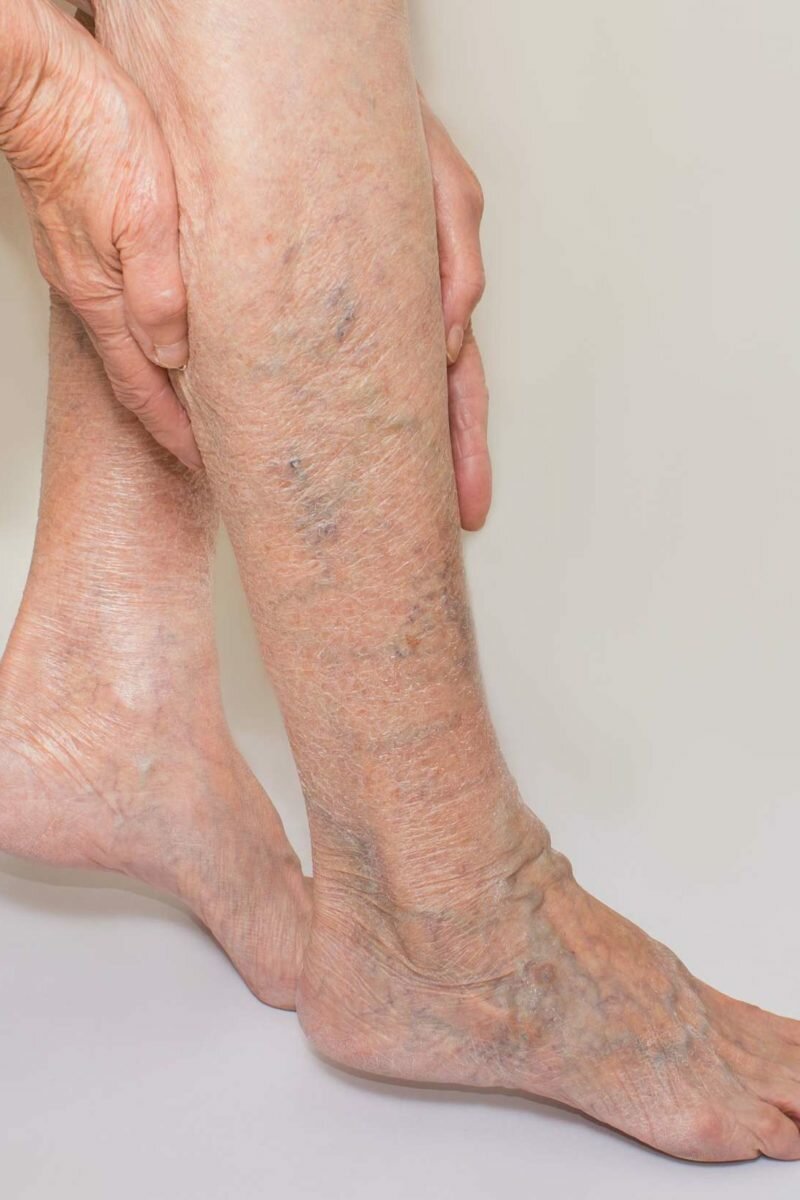 Varicose Veins Treatment