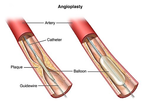 Angiography, Ballooning (Angioplasty) And Stenting