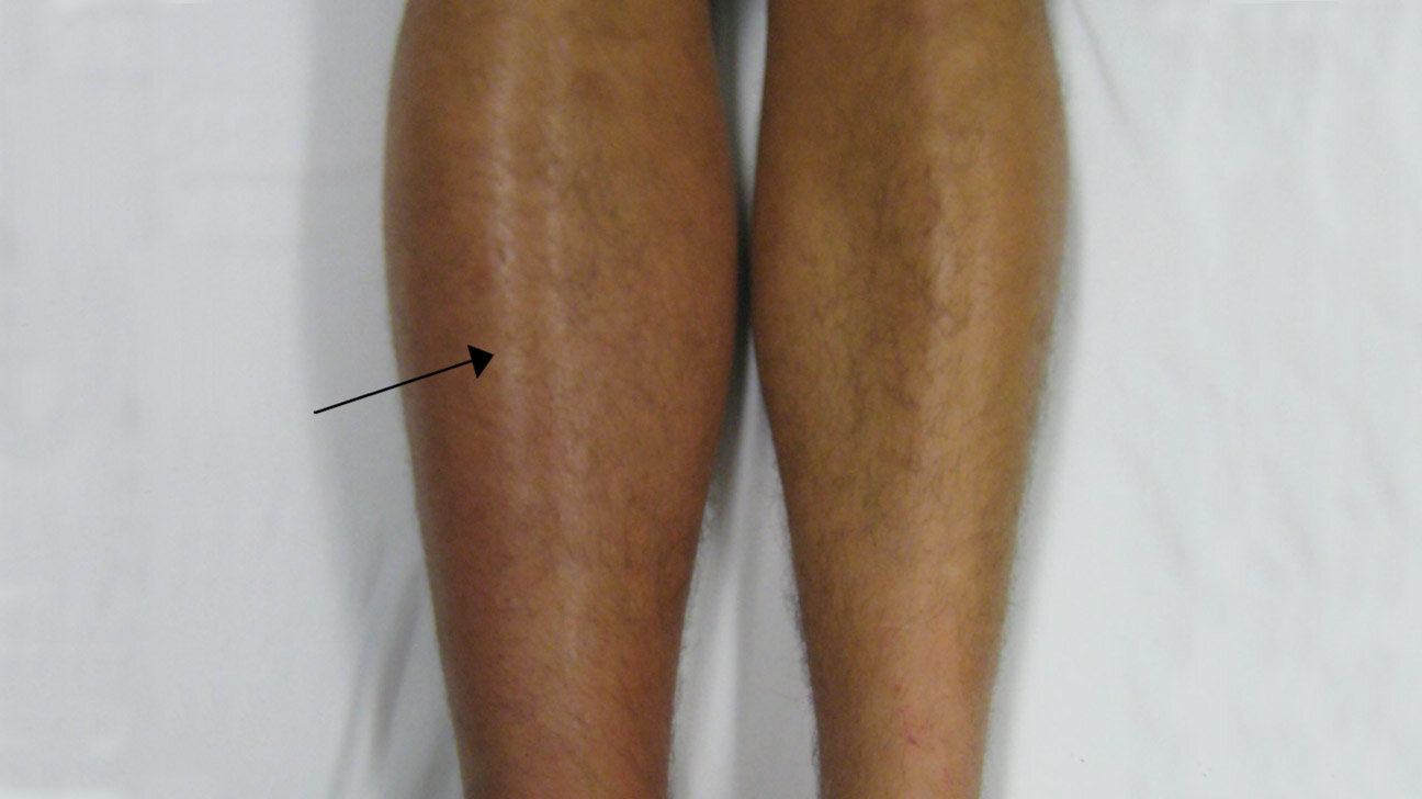 Management Of Swollen Legs/DVT