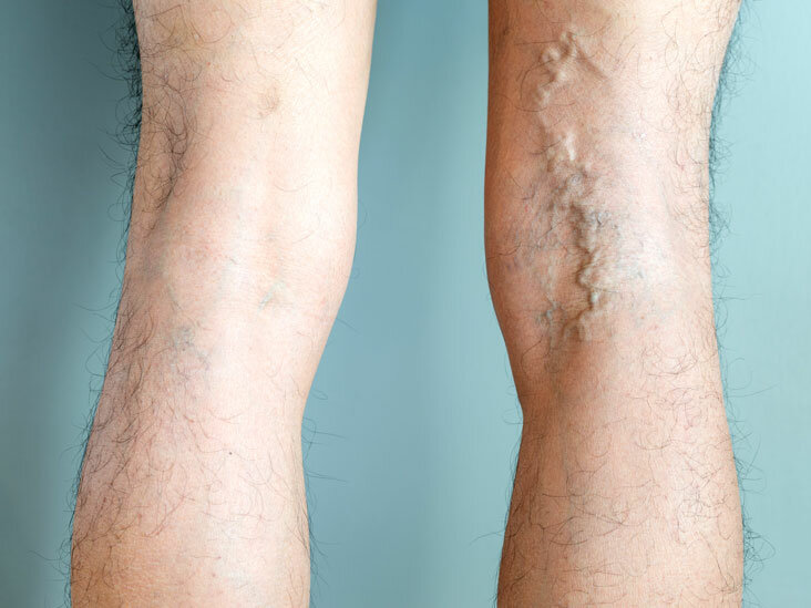 Surgery For Varicose Veins